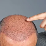 Hair Transplant: A Solution to Hair Loss and How Hair Transplant Turkey Can Help