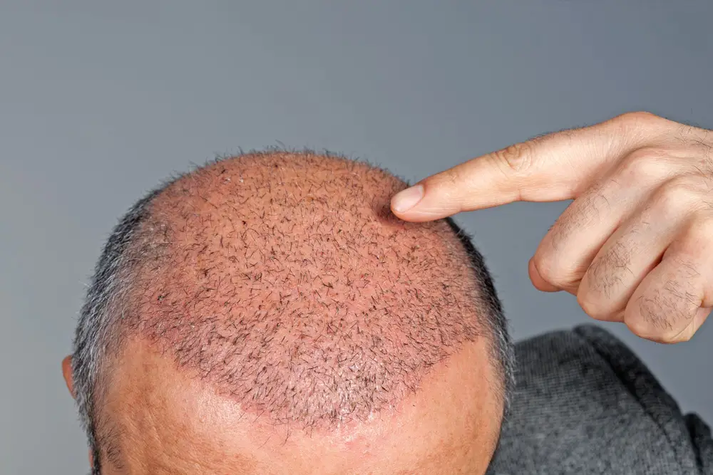 Hair Transplant: A Solution to Hair Loss and How Hair Transplant Turkey Can Help