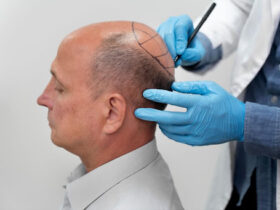 Hair Transplant in London