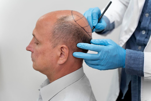 Hair Transplant in London